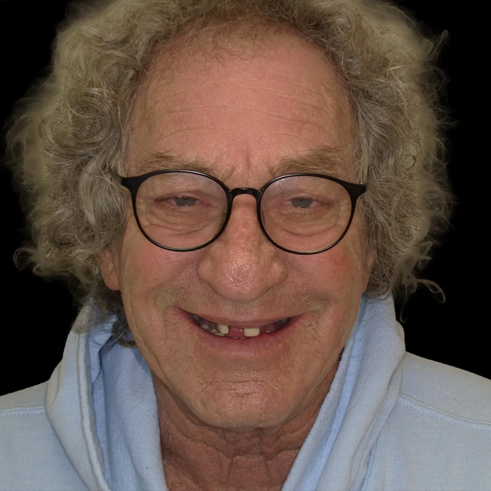 Before treatment
