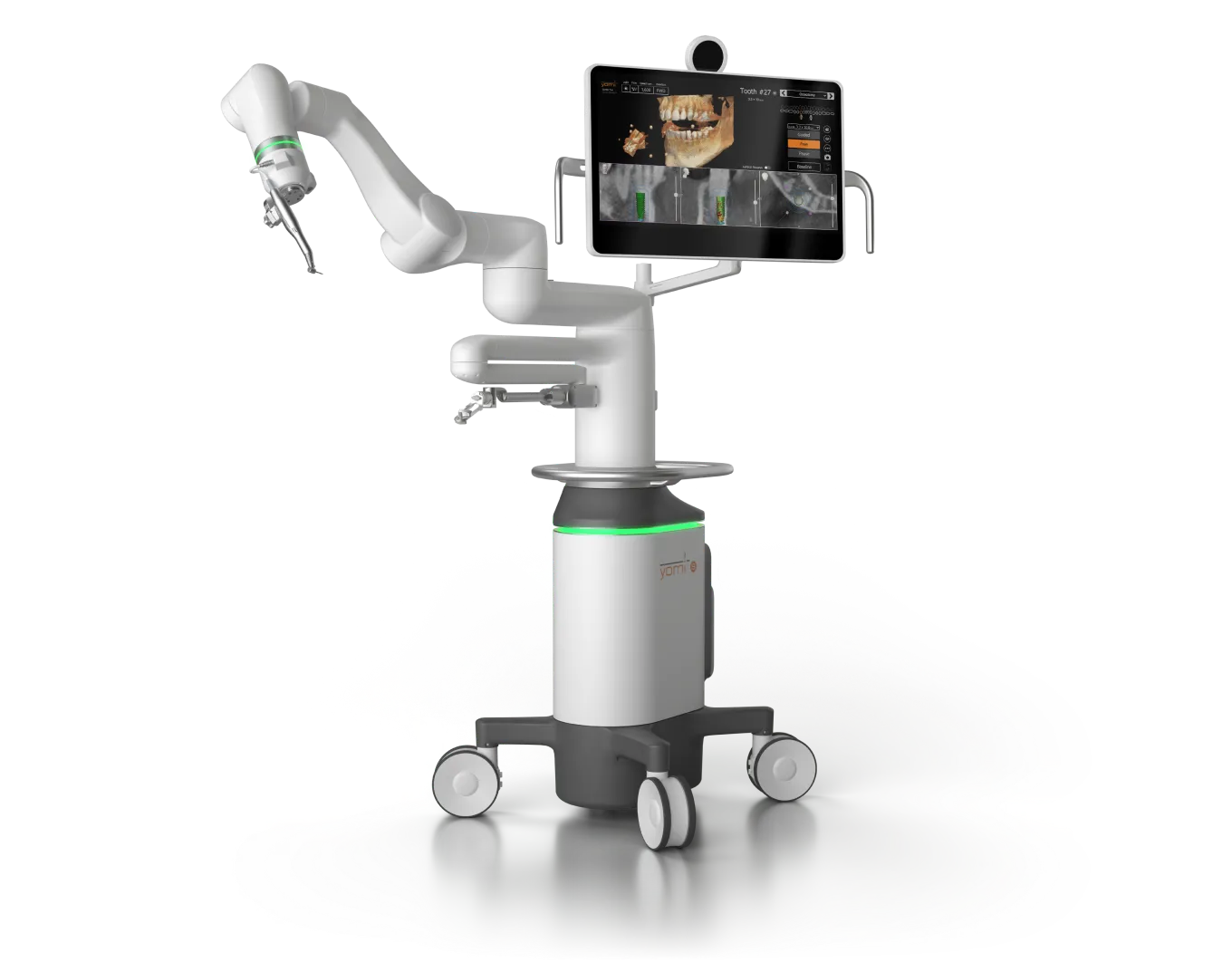Yomi robotic dental implant surgery system for precise implant placement
